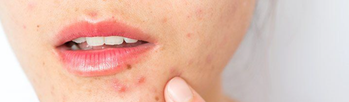 5 Causes of Adult Acne and How To Treat It